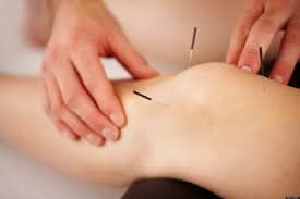 Acupuncture Treatment